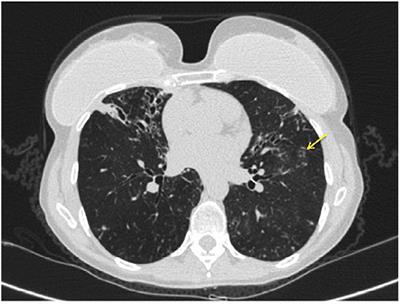 Host Variability in NTM Disease: Implications for Research Needs